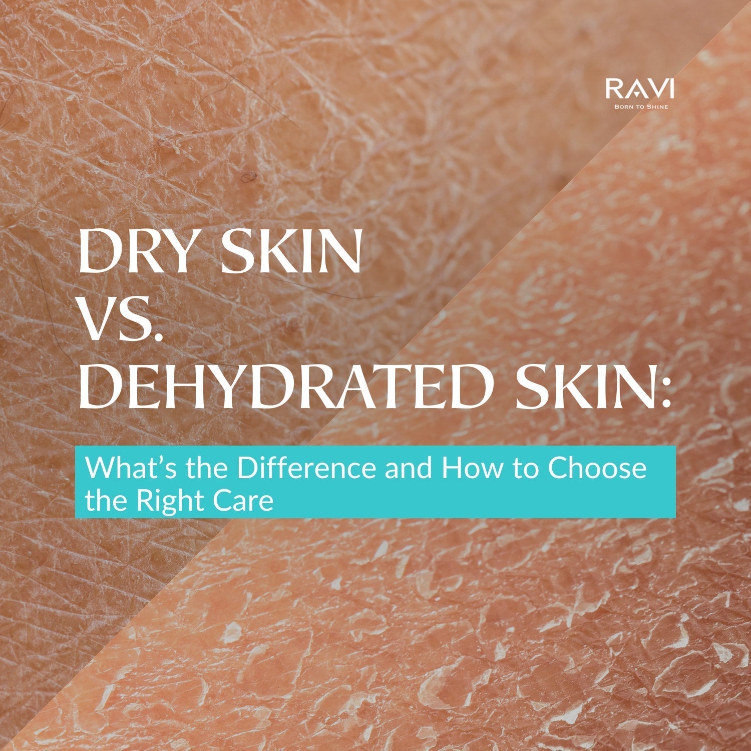 Dry Skin vs. Dehydrated Skin: What’s the Difference and How to Choose the Right Care