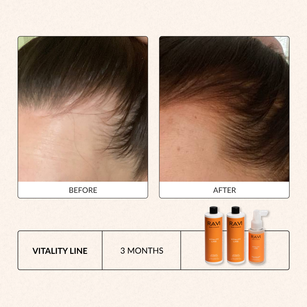 Vitality Line Anti Hair Loss Treatment Spray – RAVI